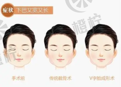 北京八大处杨斌：下颌骨整形手术技术及面部轮廓整形案例分享