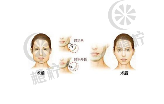 北京八大处杨斌：下颌骨整形手术技术及面部轮廓整形案例分享