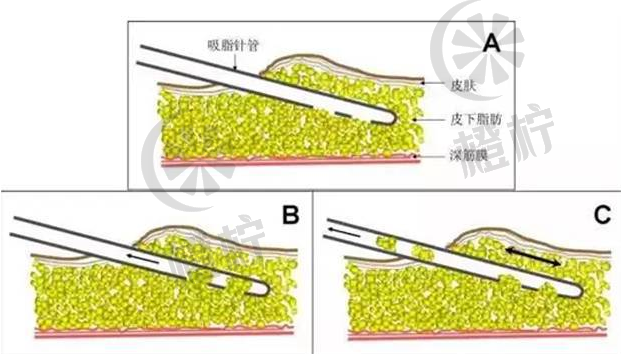 杭州时光吸脂减肥价格，案例恢复历程分享