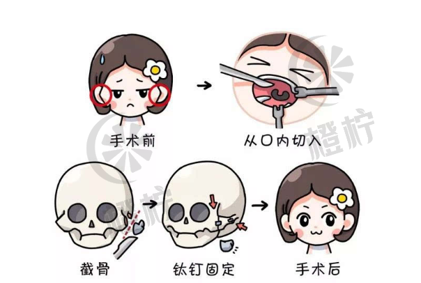 北京八大处杨斌：下颌骨整形手术技术及面部轮廓整形案例分享