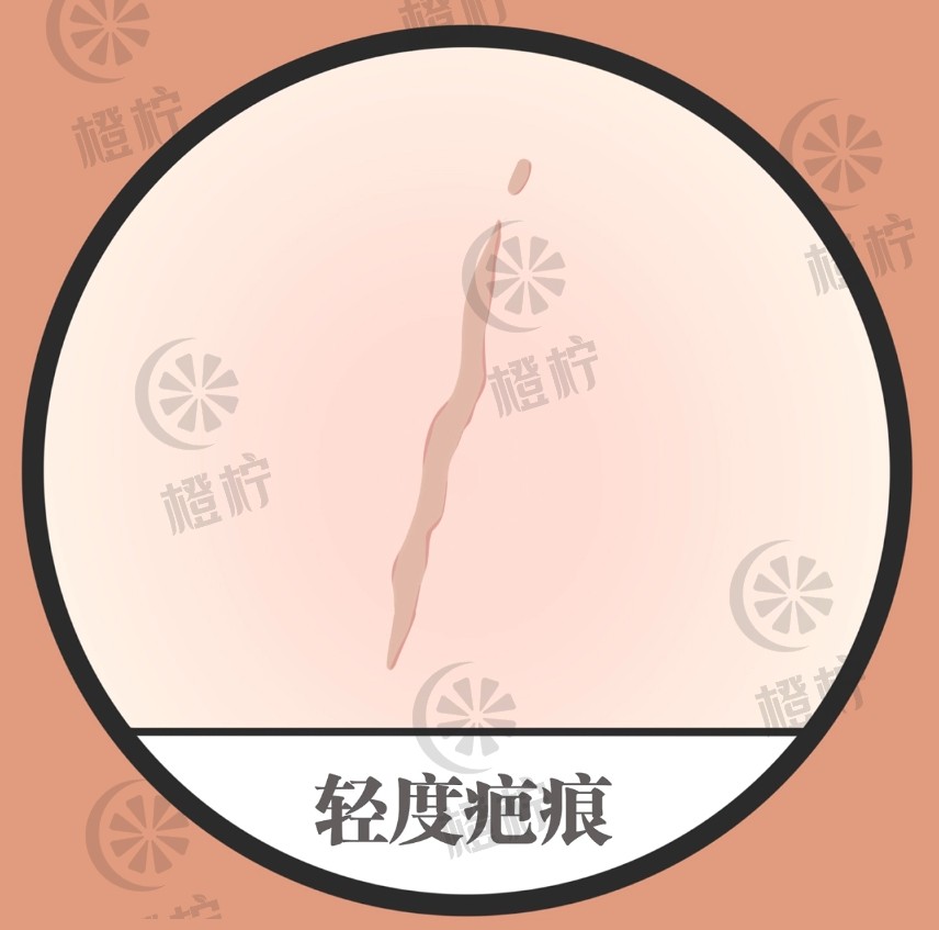 上海瑞金医院刘琰医生烧伤科祛疤案例效果及费用非常新解析