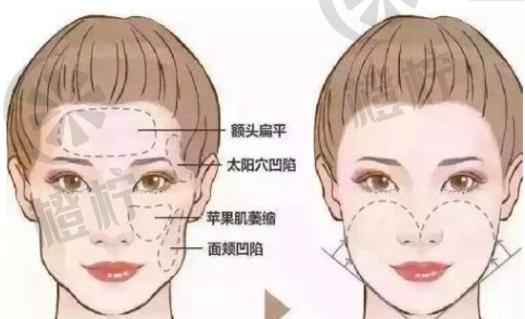 南方医科大鲁峰医生脸部脂肪填充技术如何？值得信赖吗？