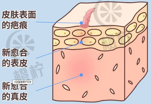 上海九院非常新疤痕修复案例分享