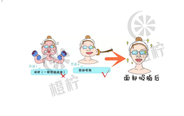 广州壹加壹美容靠谱吗？面部吸脂多久能恢复出果