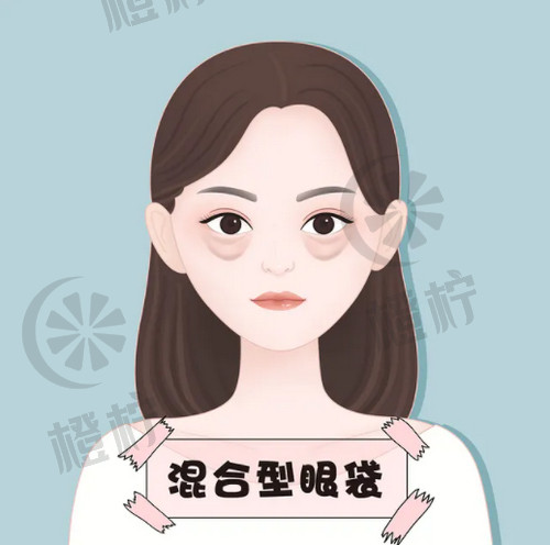厦门眼袋手术价格及资深医生推荐-非常新厦门眼袋手术费用及专家介绍