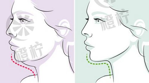 广州壹加壹美容靠谱吗？面部吸脂多久能恢复出果
