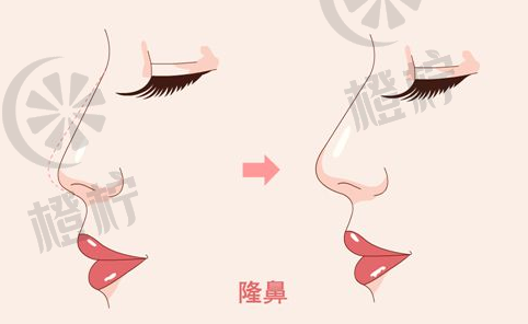 八大处医院王克明鼻部整形手术价格及术后效果案例汇总