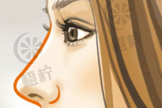 上海第九人民医院非常新隆鼻案例分享