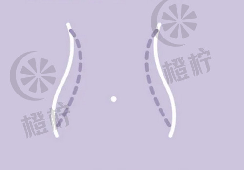 杭州熙禾医疗口碑怎么样？大腿吸脂后恢复过程经验分享