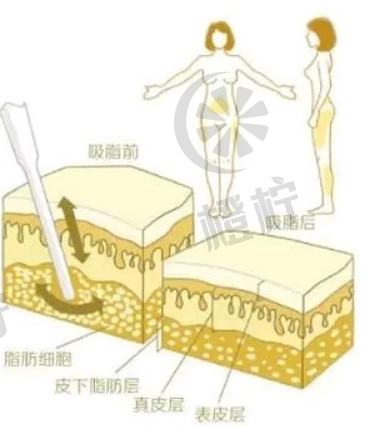 浙一医院抽脂哪个医生好？范希玲从业经历术后口碑详情