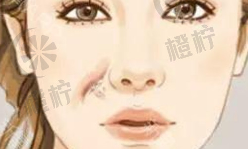 北京协和医院龙笑胎记手术效果如何？胎记去除价格贵吗？非常新案例分析【2021非常新】
