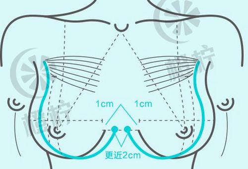 上海九院羽医生隆胸技术实力如何？非常新案例展示，效果惊艳!