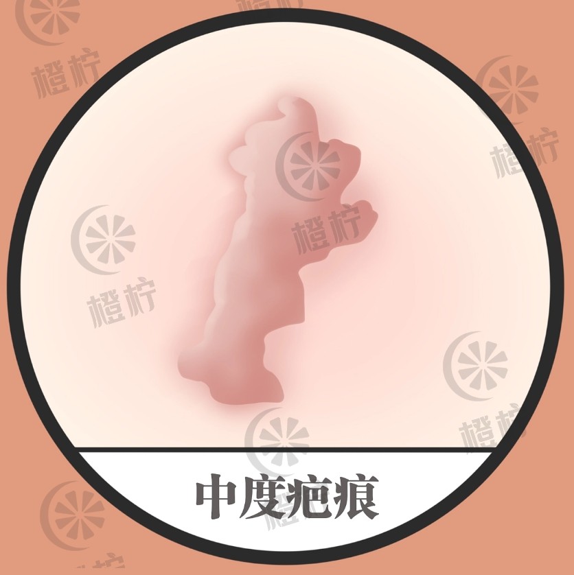 上海九院非常新疤痕修复案例分享|刘伟医生祛疤效果如何？